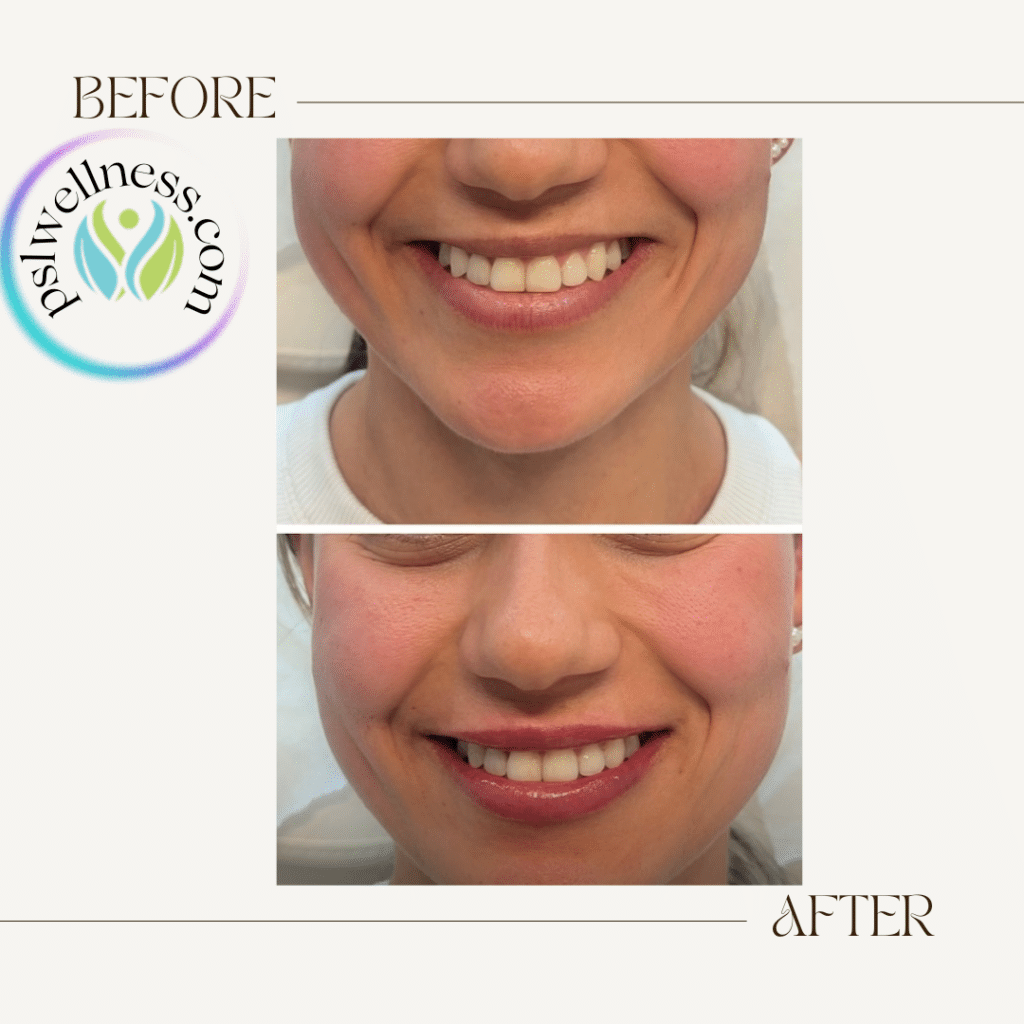 Before + After Lip Filler