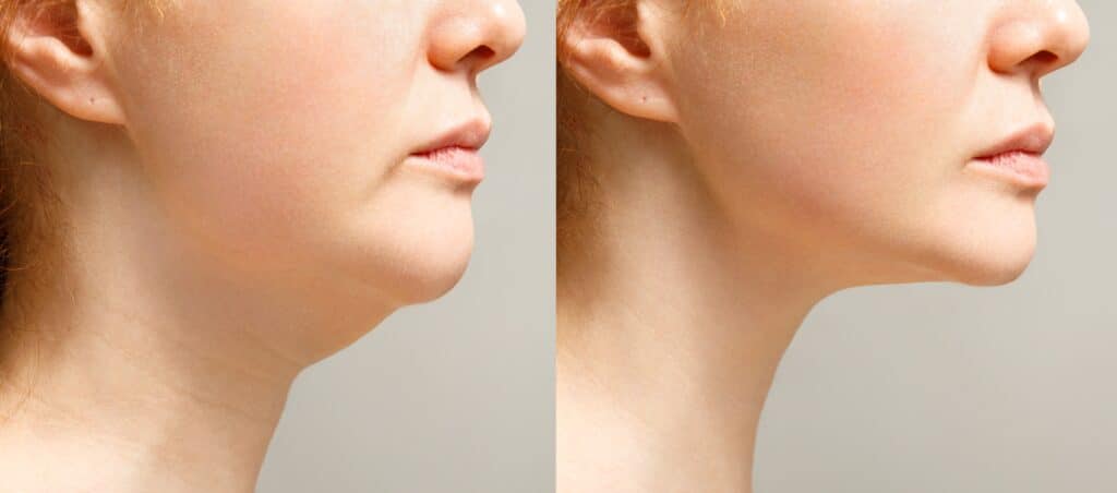Woman's profile view, before and after double chin treatment