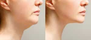Woman's profile view, before and after double chin treatment