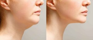 Woman's profile view, before and after double chin treatment