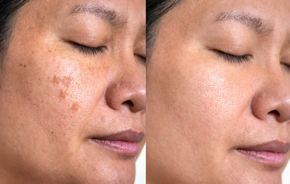 Woman with sun spots, before and after IPL pigment removal
