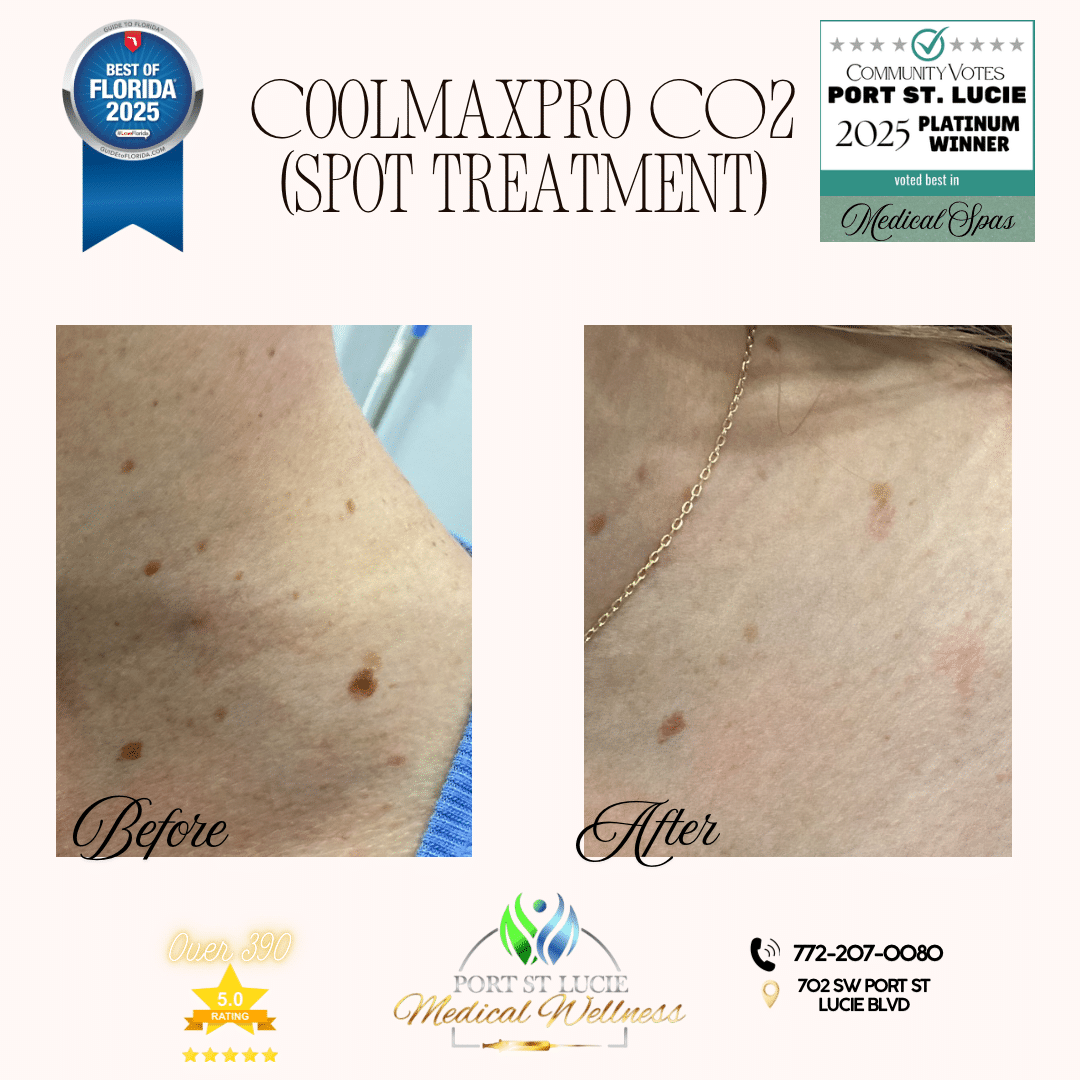 Before and After Image: COOLMAXPRO CO2 - left-front-oblique