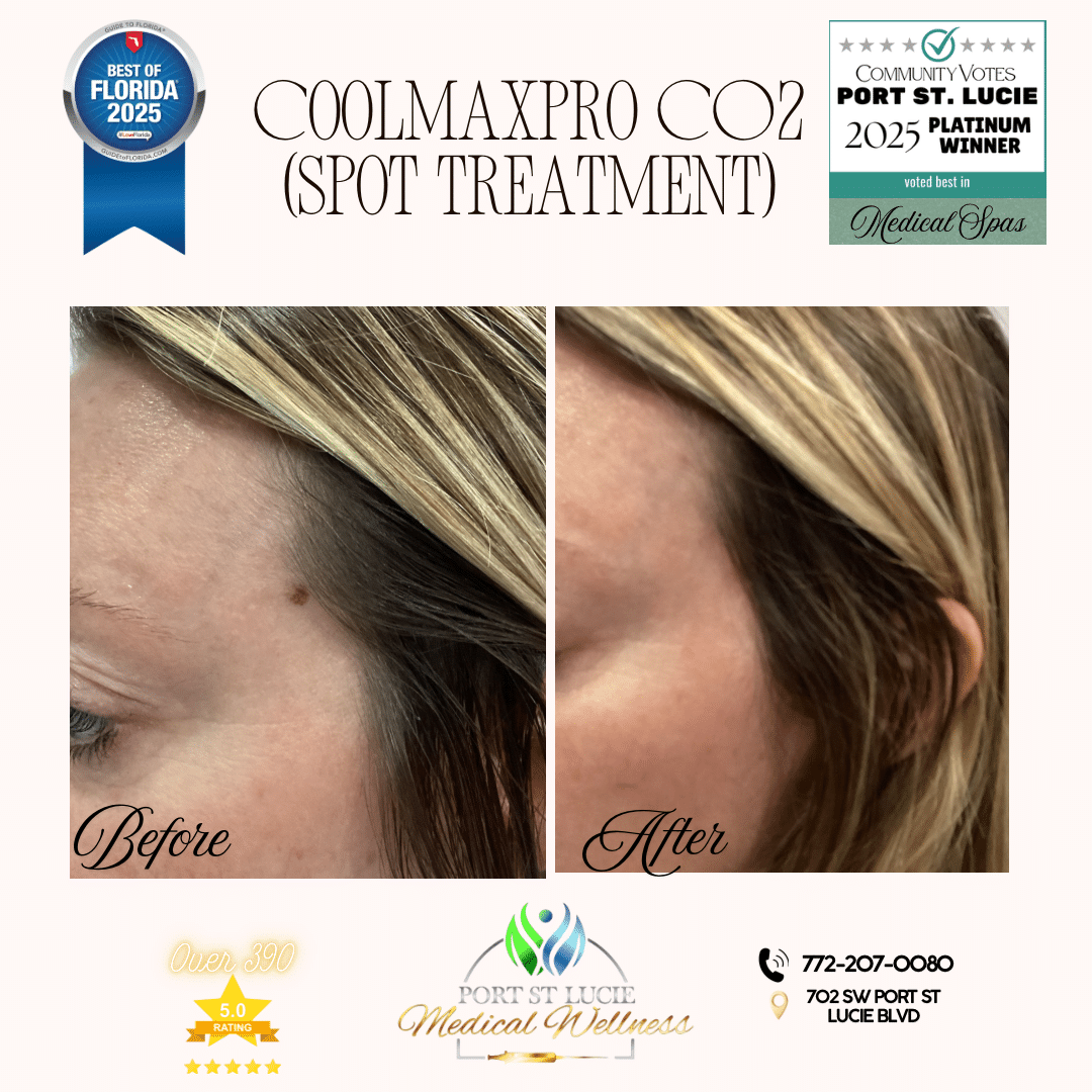 Before and After Image: COOLMAXPRO CO2 - left-front-oblique