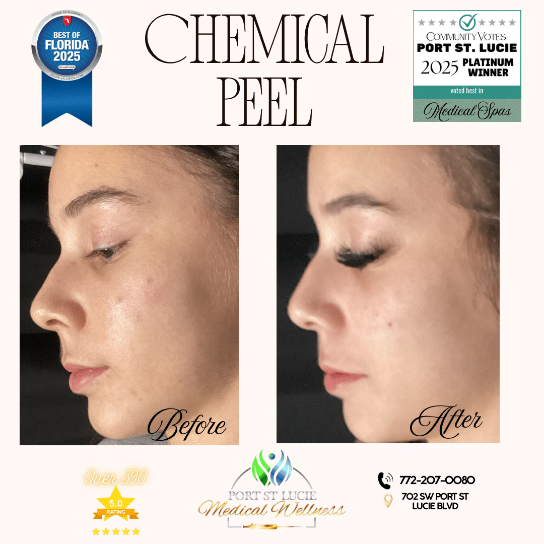 Before and After Image: Chemical Peel - left-side