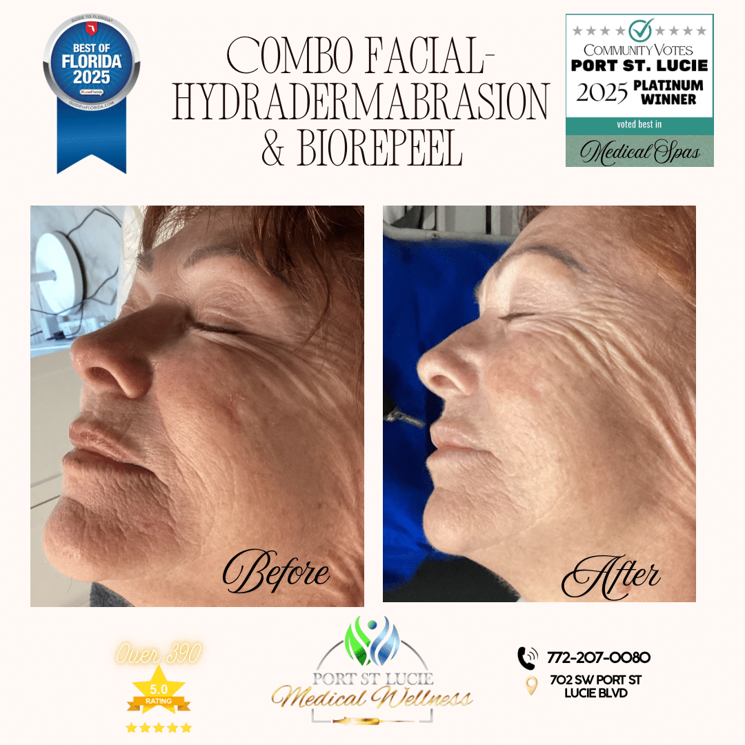 Before and After Image: Combo Facial – Hydradermabrasion & Biorepeel - left-front-oblique