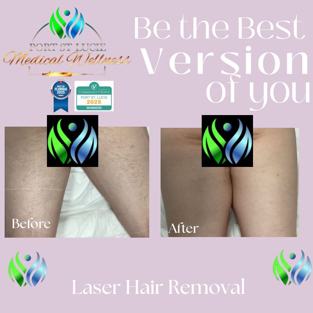 Before and After Image: Laser Hair Removal - front