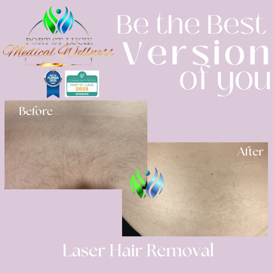 Before and After Image: Laser Hair Removal - front
