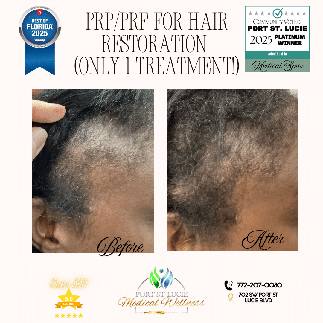 Before and After Image: PRP/PRF for Hair Restoration (Only 1 Treatment) - right-front-oblique